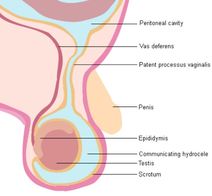 hydrocele treatment