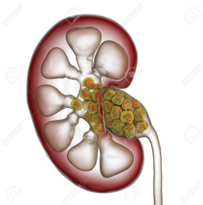 types of kidney stones in men